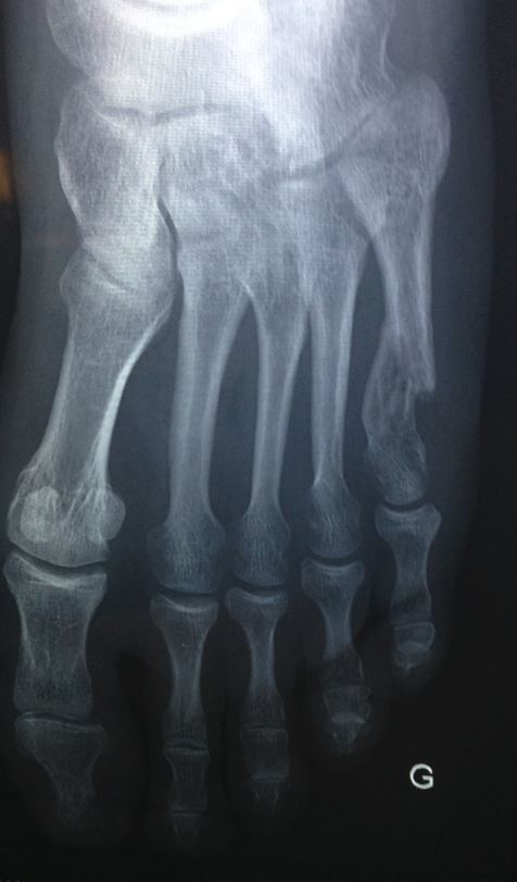 fracture consolidée.JPG